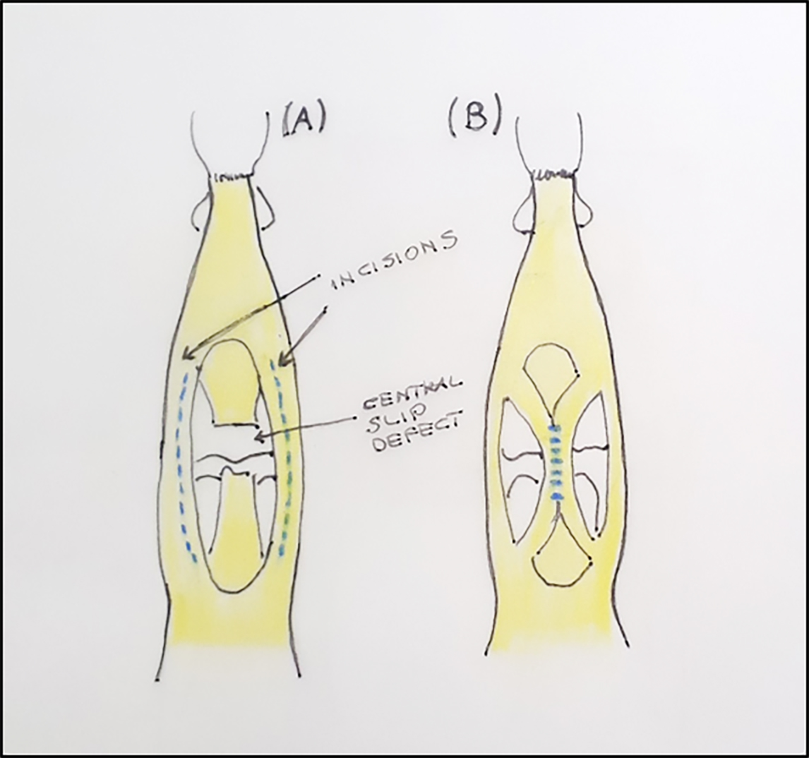 Reconstruction of tendon losses