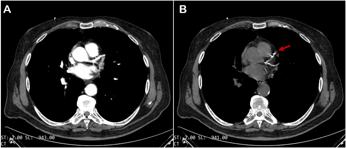 Contemporary approach to heavily calcified lesions: tools of the trade, challenges, and pitfalls