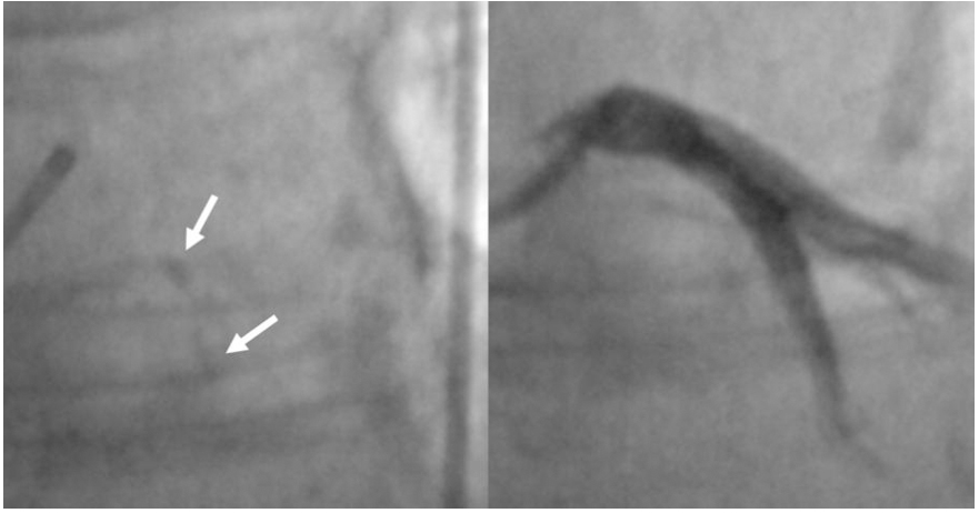 Contemporary approach to heavily calcified lesions: tools of the trade, challenges, and pitfalls