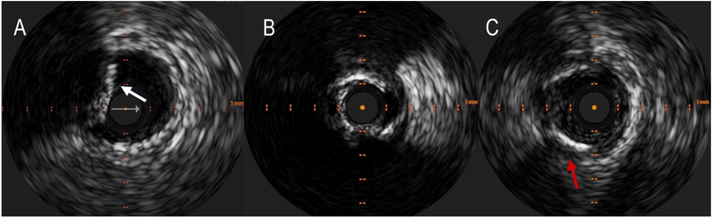 Contemporary approach to heavily calcified lesions: tools of the trade, challenges, and pitfalls