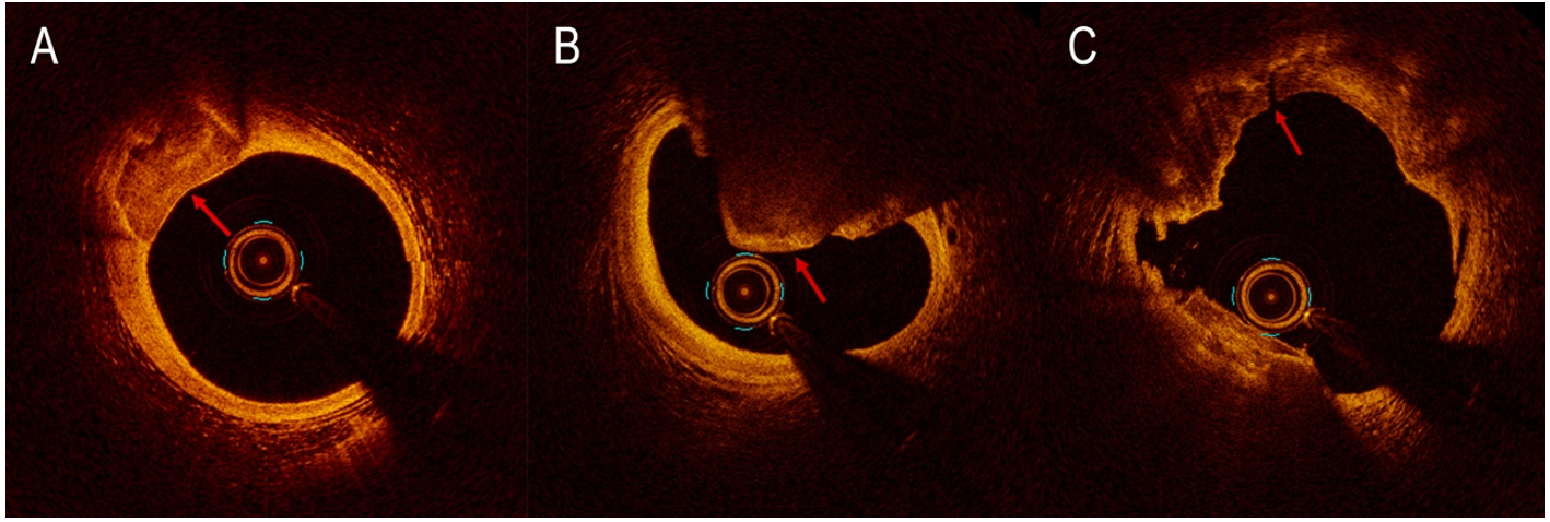 Contemporary approach to heavily calcified lesions: tools of the trade, challenges, and pitfalls