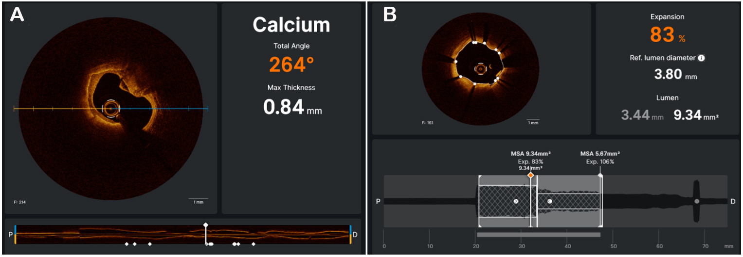 Contemporary approach to heavily calcified lesions: tools of the trade, challenges, and pitfalls