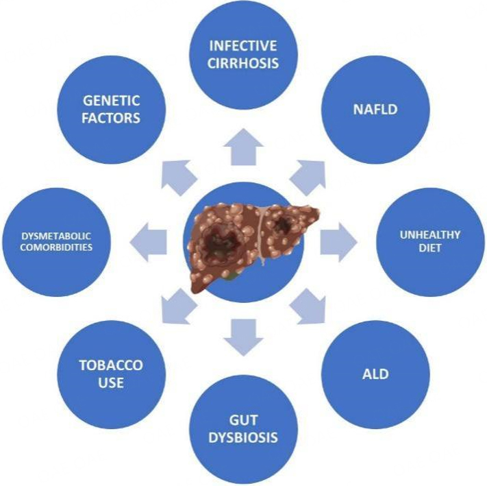 Impact of diet and gut microbiota changes in the development of hepatocellular carcinoma