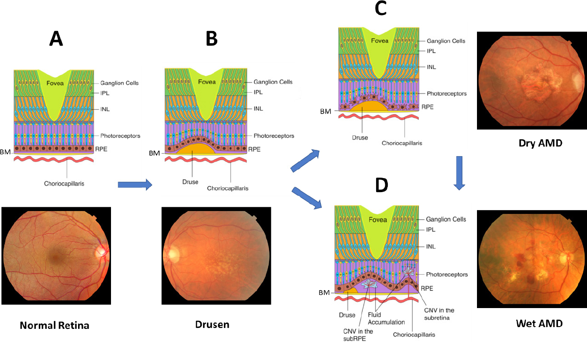 The interplay of oxidative stress and ARMS2-HTRA1 genetic risk in neovascular AMD