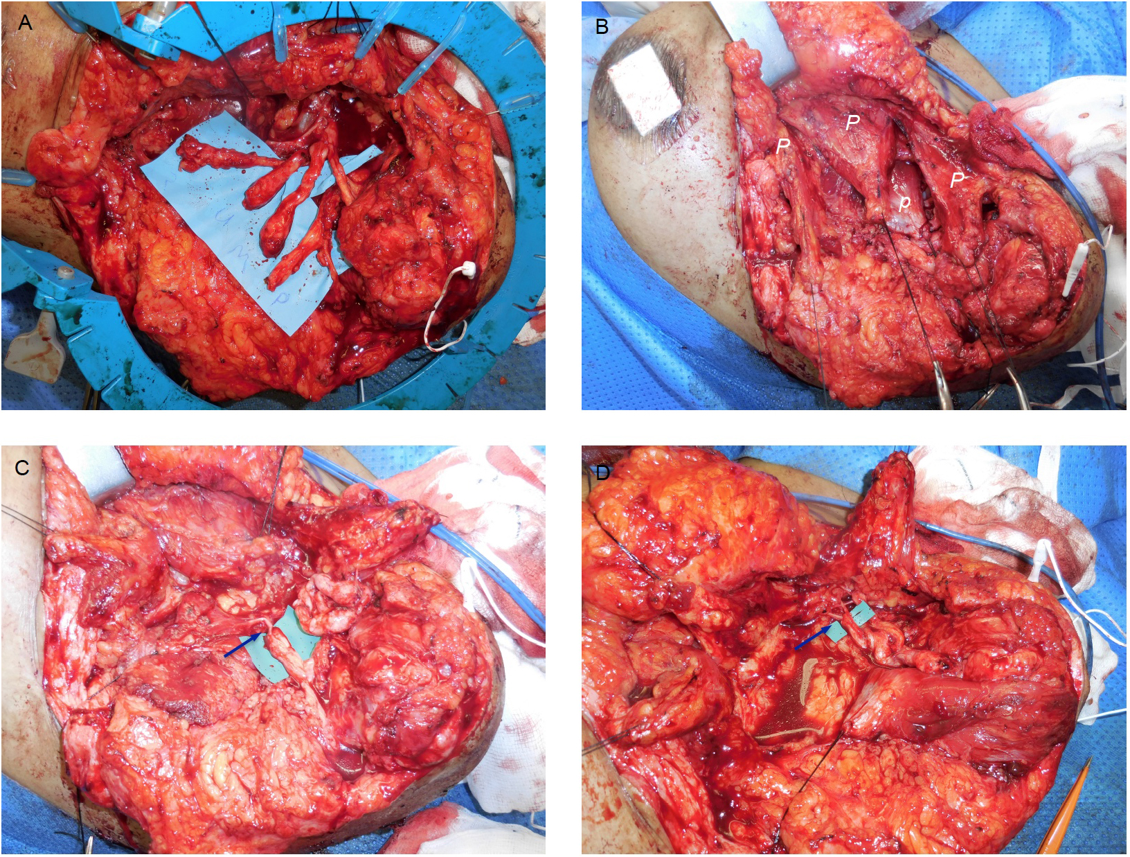 Advances in upper limb loss rehabilitation: the role of targeted muscle reinnervation and regenerative peripheral nerve interfaces