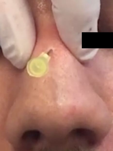 Nonsurgical rhinoplasty using soft tissue fillers