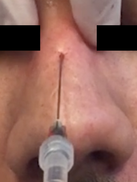 Nonsurgical rhinoplasty using soft tissue fillers