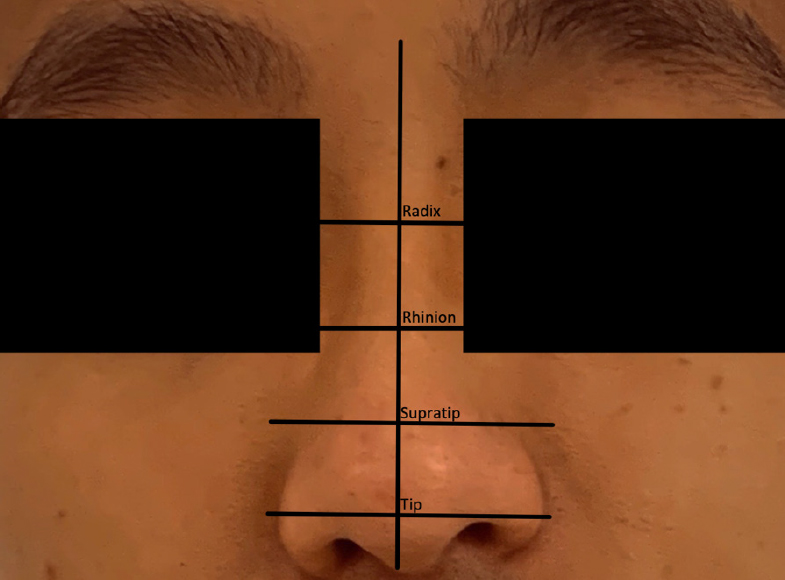 Nonsurgical rhinoplasty using soft tissue fillers