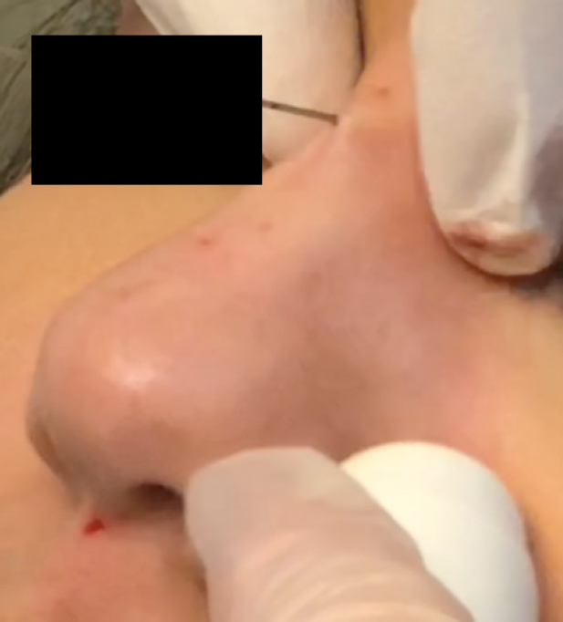 Nonsurgical rhinoplasty using soft tissue fillers