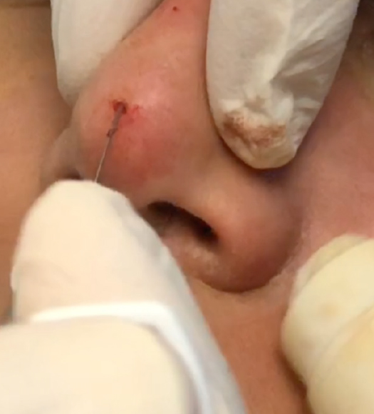 Nonsurgical rhinoplasty using soft tissue fillers