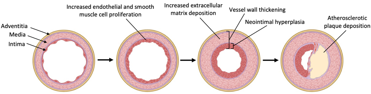 The biomechanics and prevention of vein graft failure in coronary revascularization