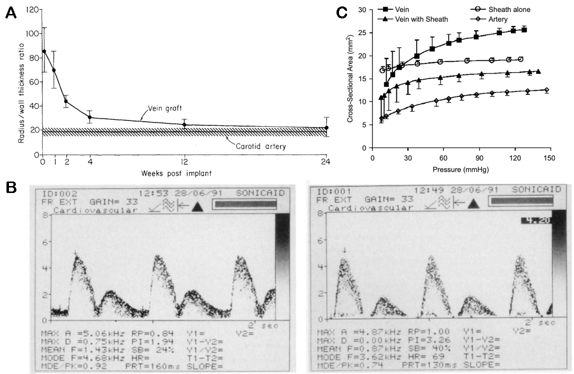 The biomechanics and prevention of vein graft failure in coronary revascularization