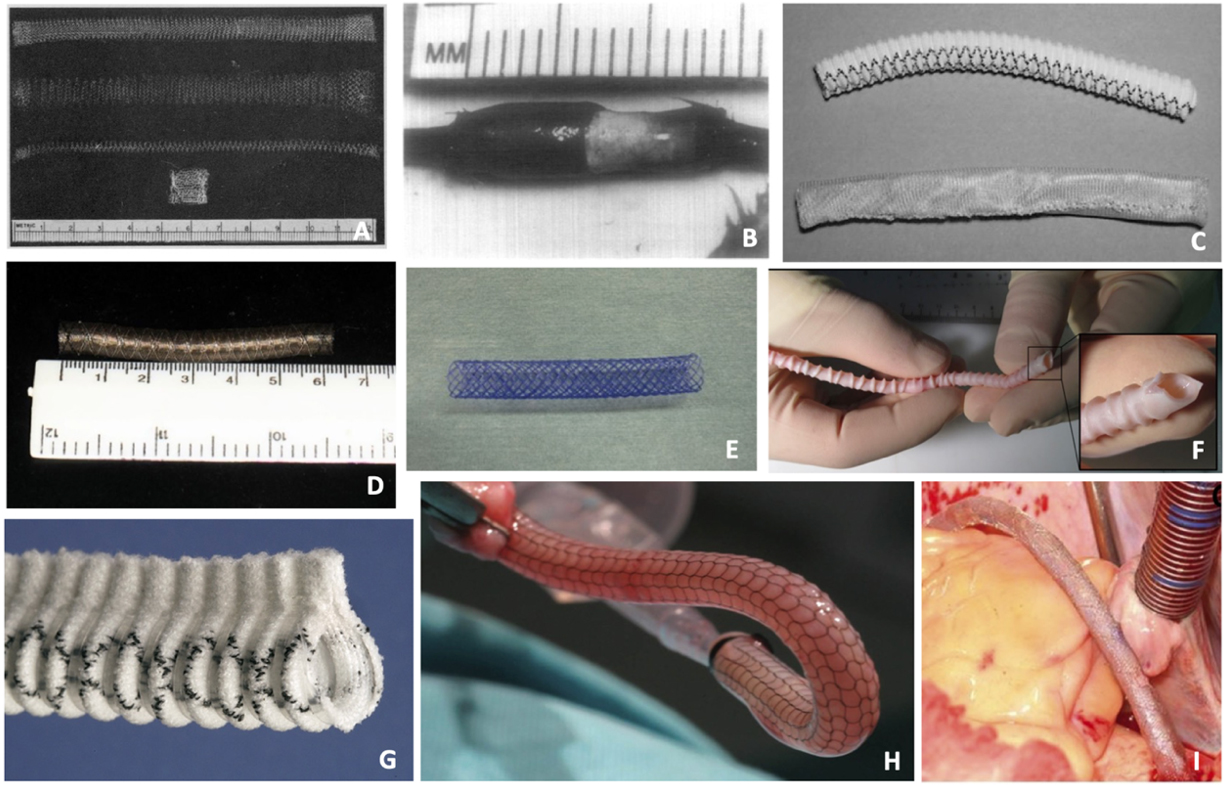 The biomechanics and prevention of vein graft failure in coronary revascularization