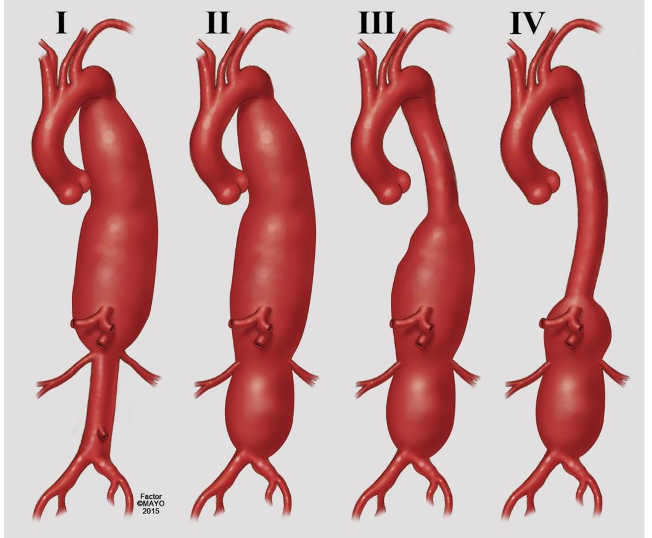 Current state of endovascular repair of thoracoabdominal aortic aneurysms