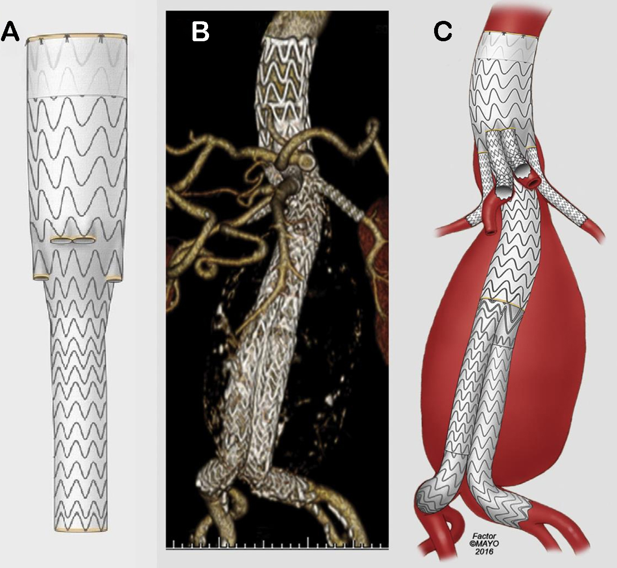 Current state of endovascular repair of thoracoabdominal aortic aneurysms
