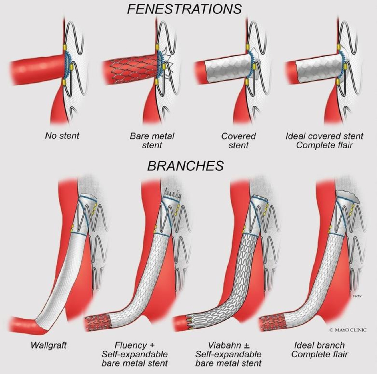 Current state of endovascular repair of thoracoabdominal aortic aneurysms