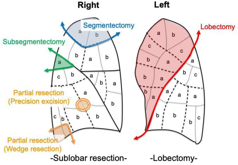 Indications and technical details of sublobar resections for small