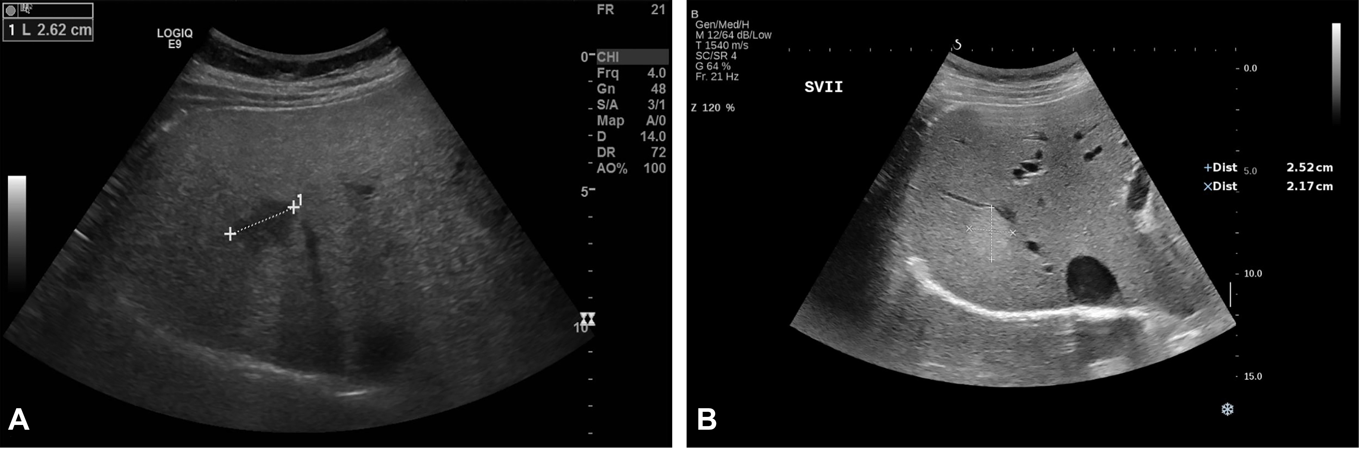 Sonography in surveillance for HCC in NAFLD patients