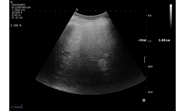 Sonography in surveillance for HCC in NAFLD patients