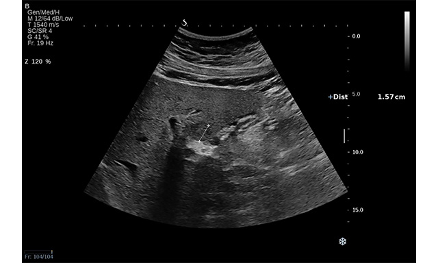 Sonography in surveillance for HCC in NAFLD patients