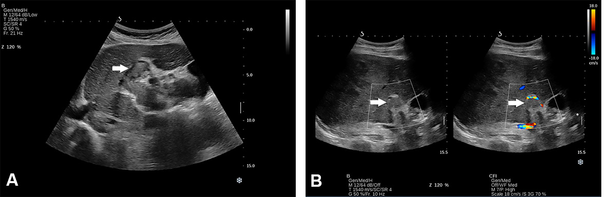 Sonography in surveillance for HCC in NAFLD patients