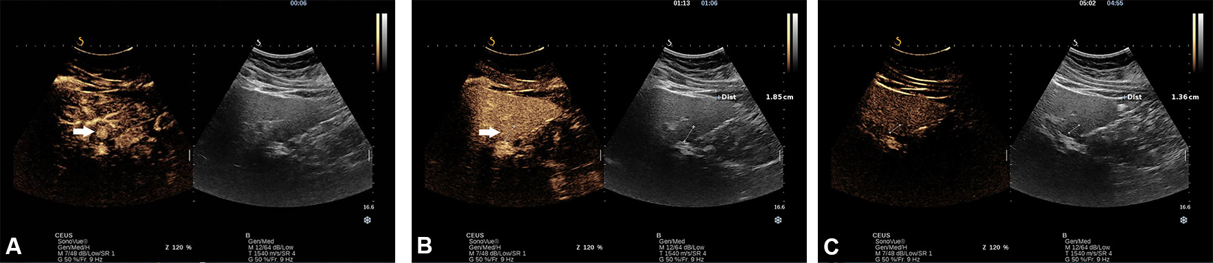 Sonography in surveillance for HCC in NAFLD patients