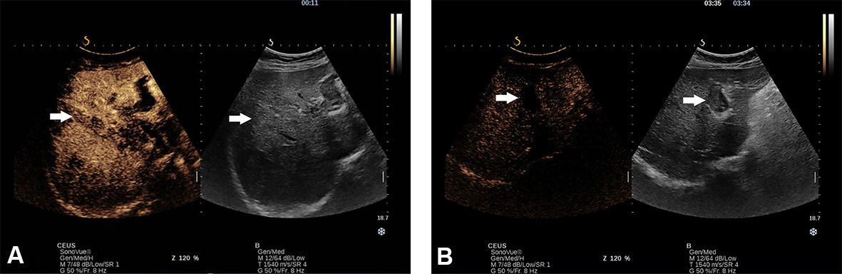 Sonography in surveillance for HCC in NAFLD patients