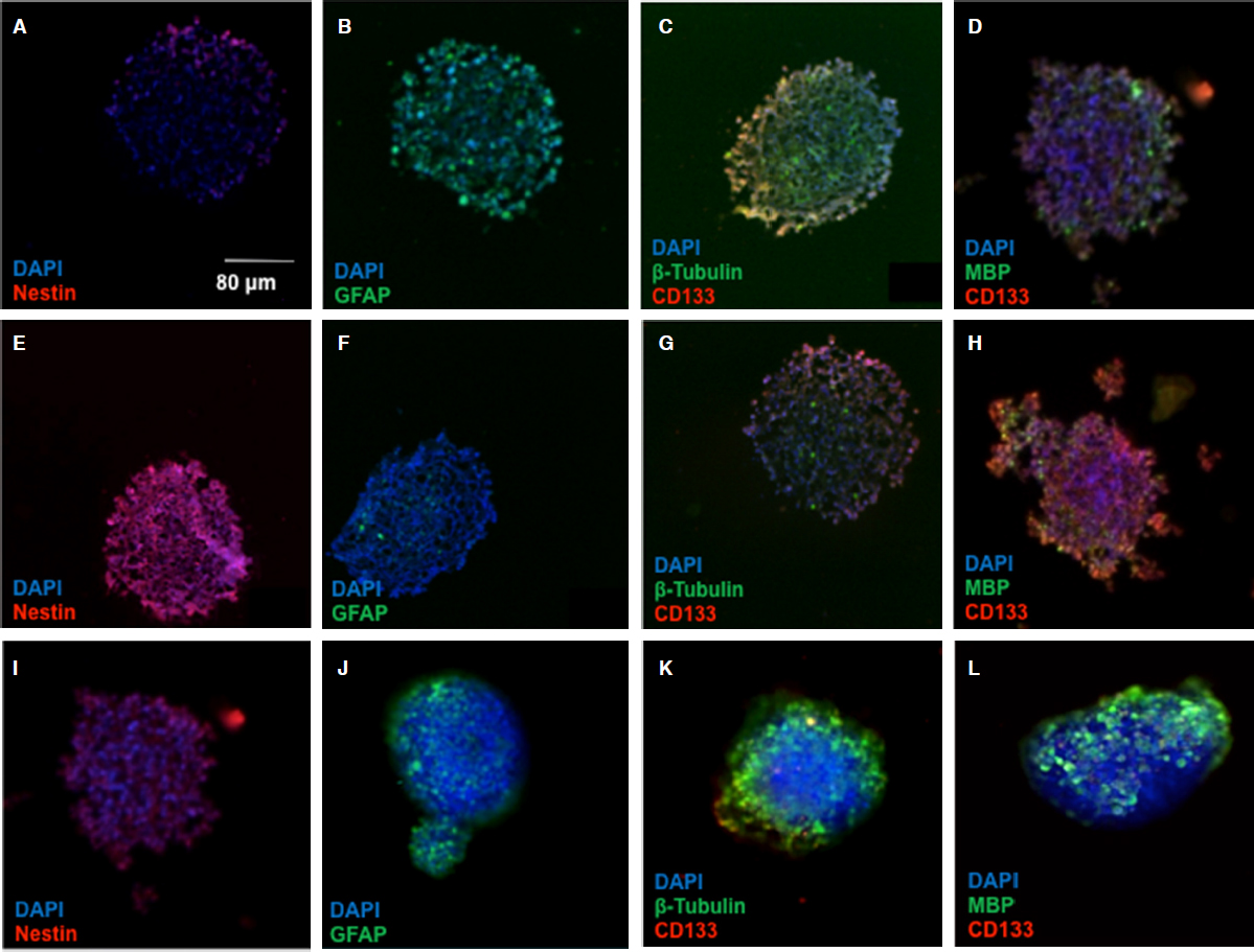 Gene silencing of HIF-2α disrupts glioblastoma stem cell phenotype