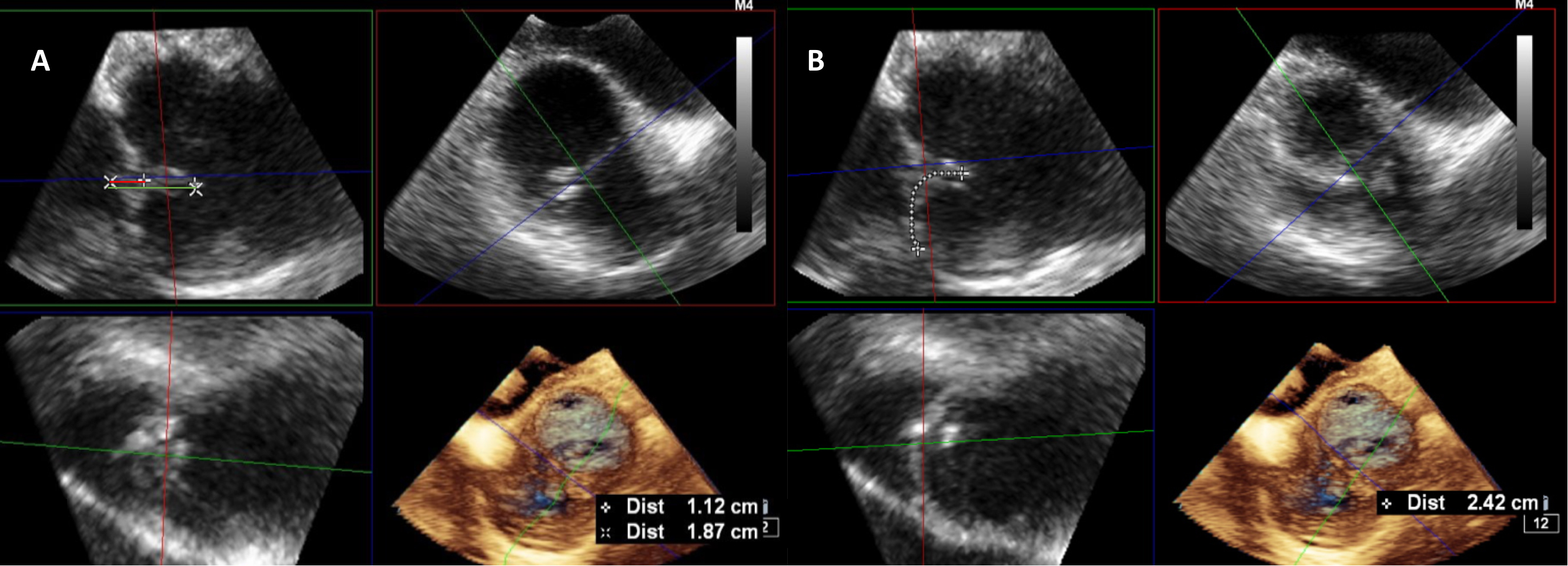 3D echocardiography to plan aortic valve surgery and evaluate the results