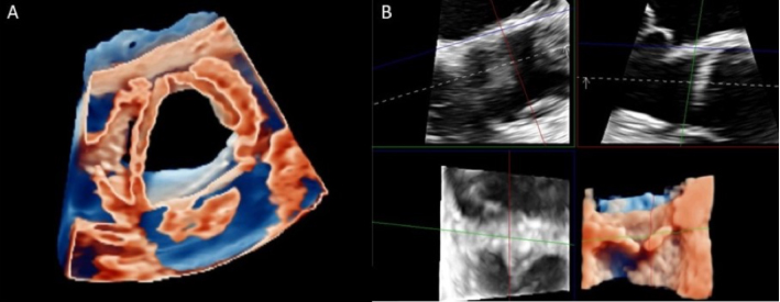 3D echocardiography to plan aortic valve surgery and evaluate the results