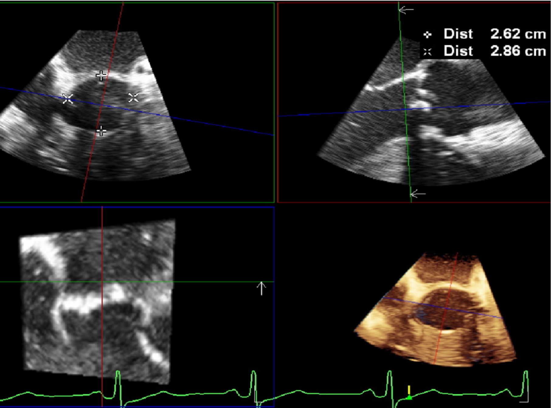 3D echocardiography to plan aortic valve surgery and evaluate the results