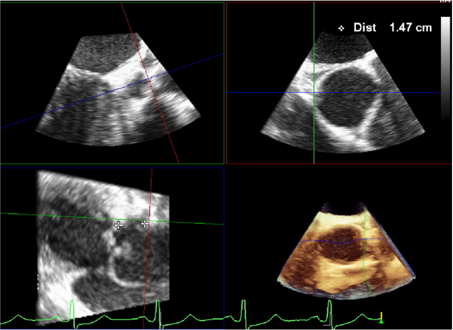 3D echocardiography to plan aortic valve surgery and evaluate the results