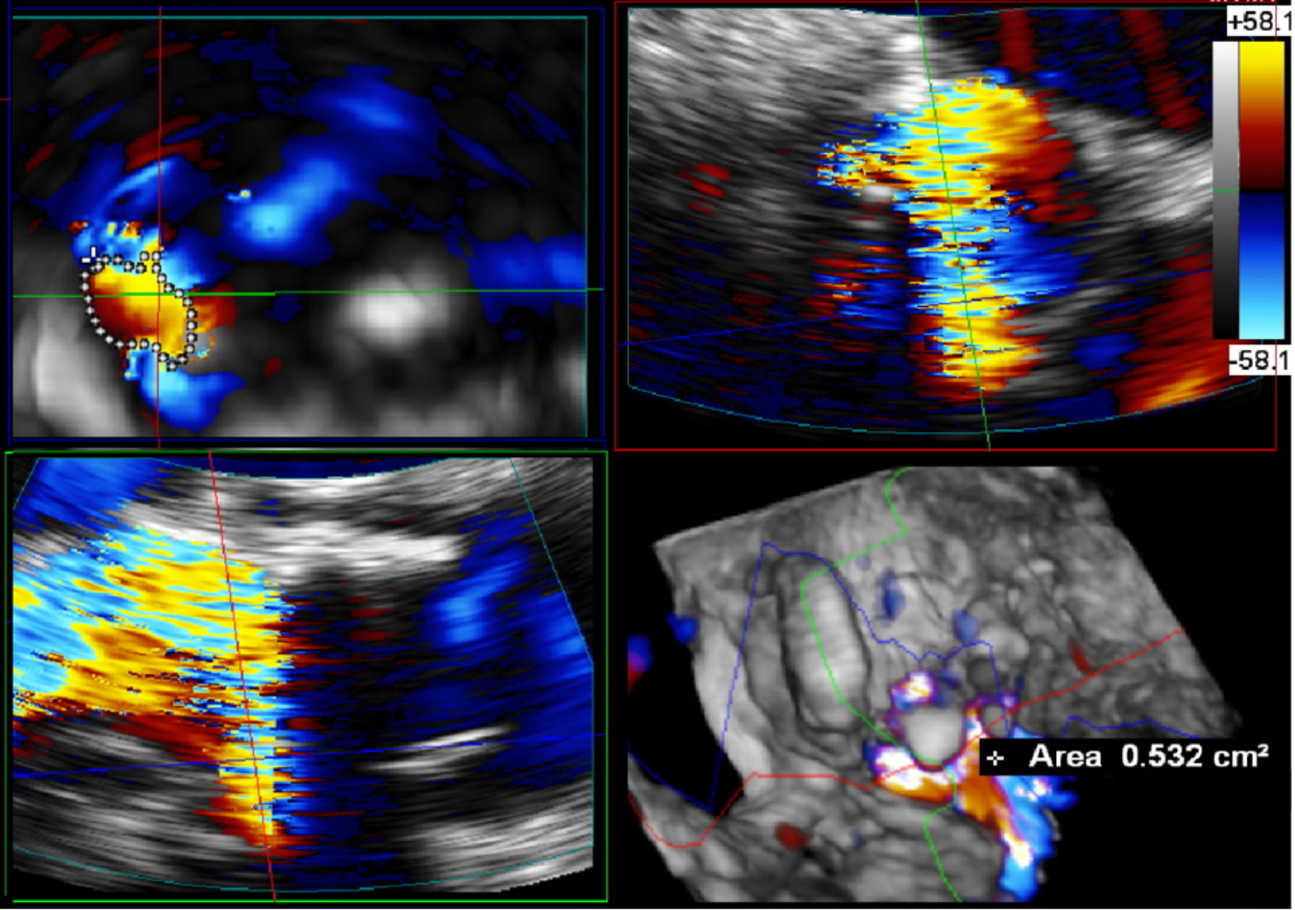 3D echocardiography to plan aortic valve surgery and evaluate the results