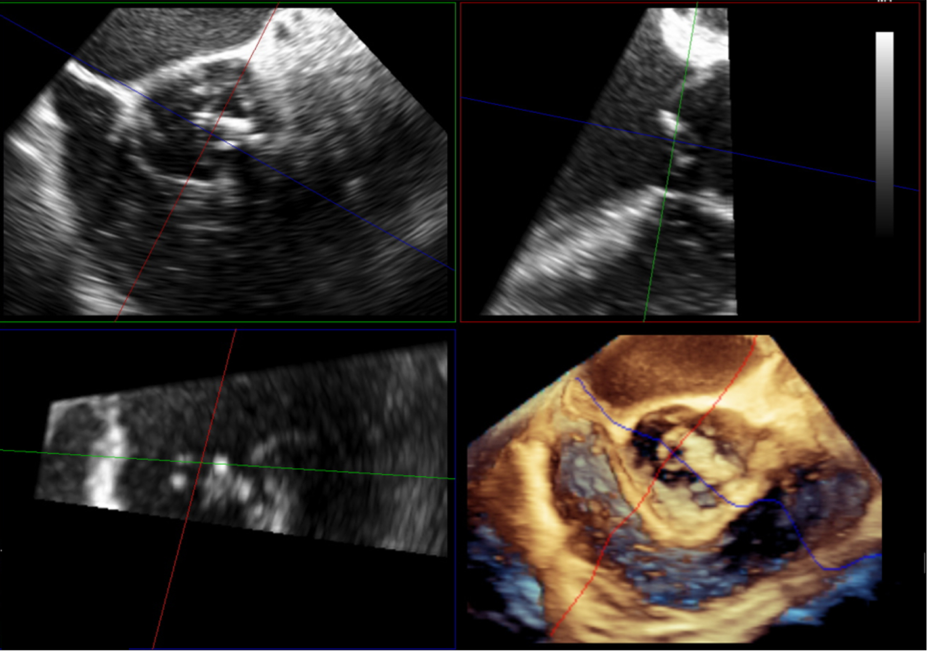 3D echocardiography to plan aortic valve surgery and evaluate the results