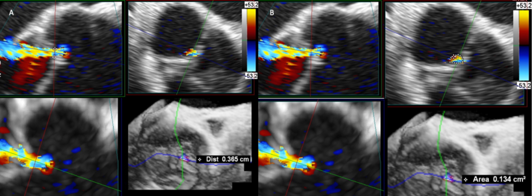 3D echocardiography to plan aortic valve surgery and evaluate the results