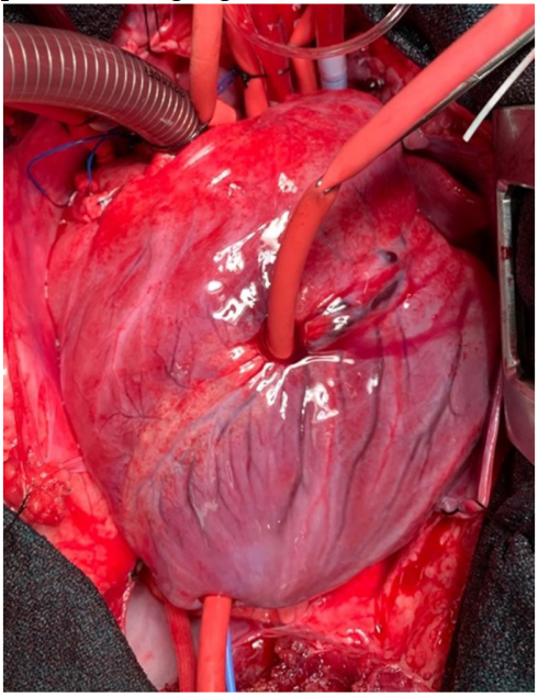 Exploitation of K<sub>ATP</sub> channels for cardiac surgery