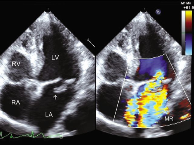 Echocardiographic Evaluation Of Mitral Valve Regurgitation