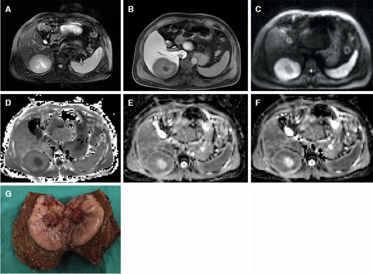 Imaging biomarkers for predicting poor prognosis of hepatocellular carcinoma: a review