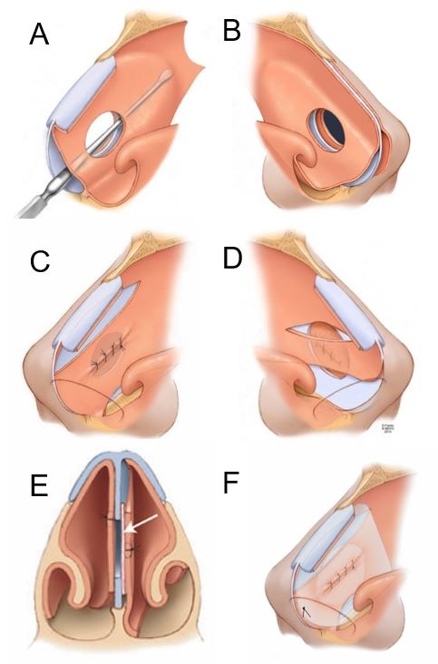 Septal perforation