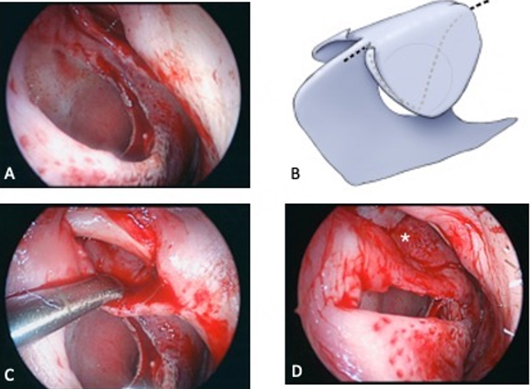 Septal perforation