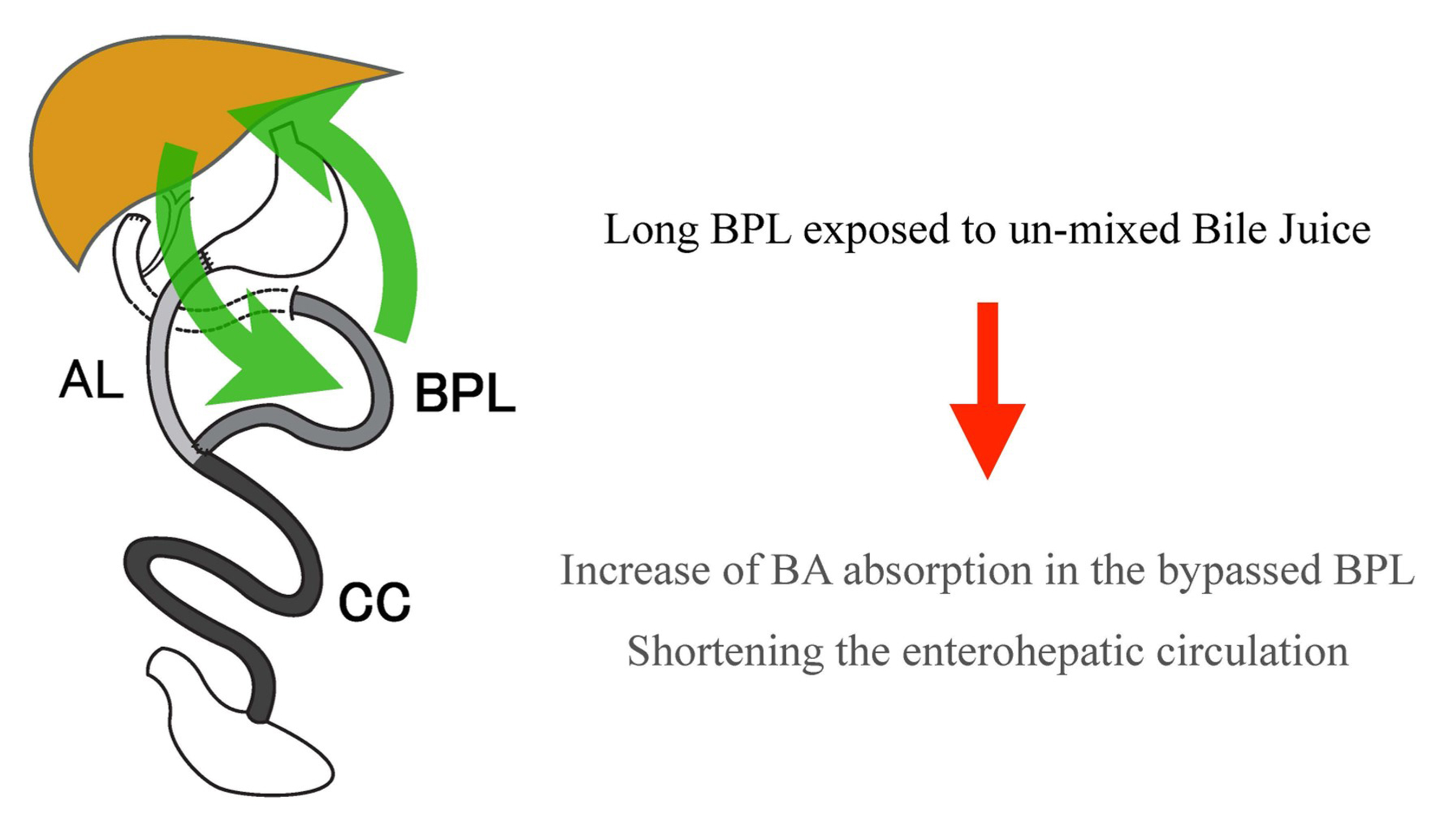Mechanism of metabolic surgery for the treatment of Type 2 Diabetes Mellitus (T2DM)