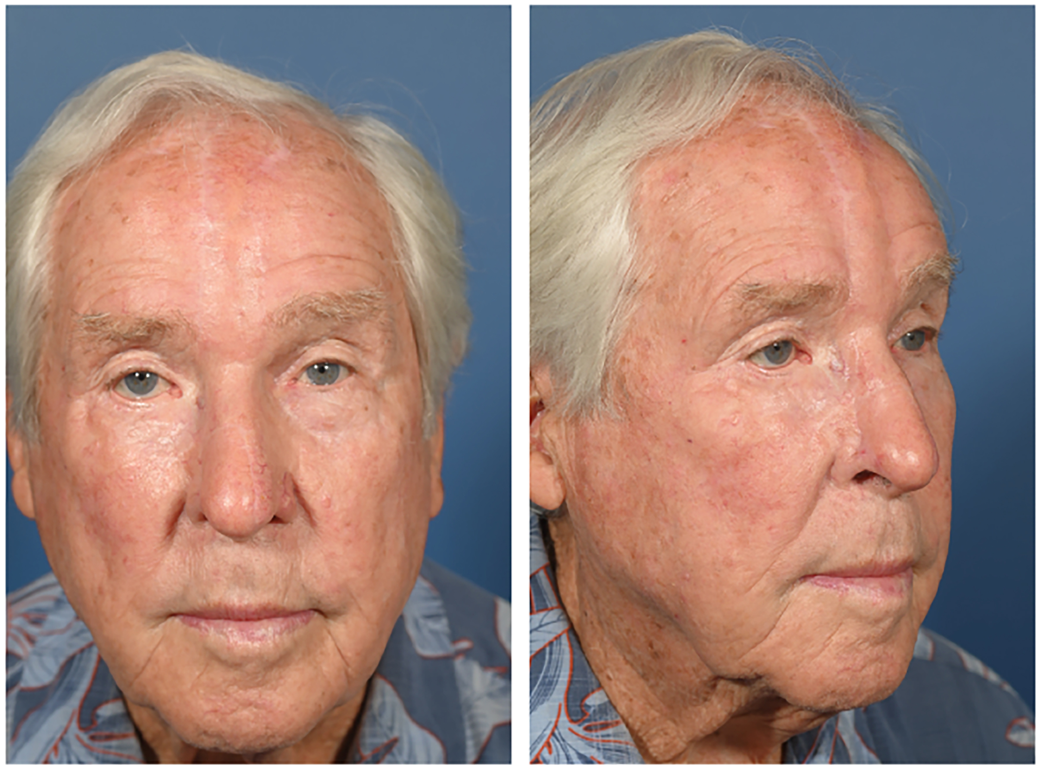 The forehead flap in nasal reconstruction: overview and updates in evidence