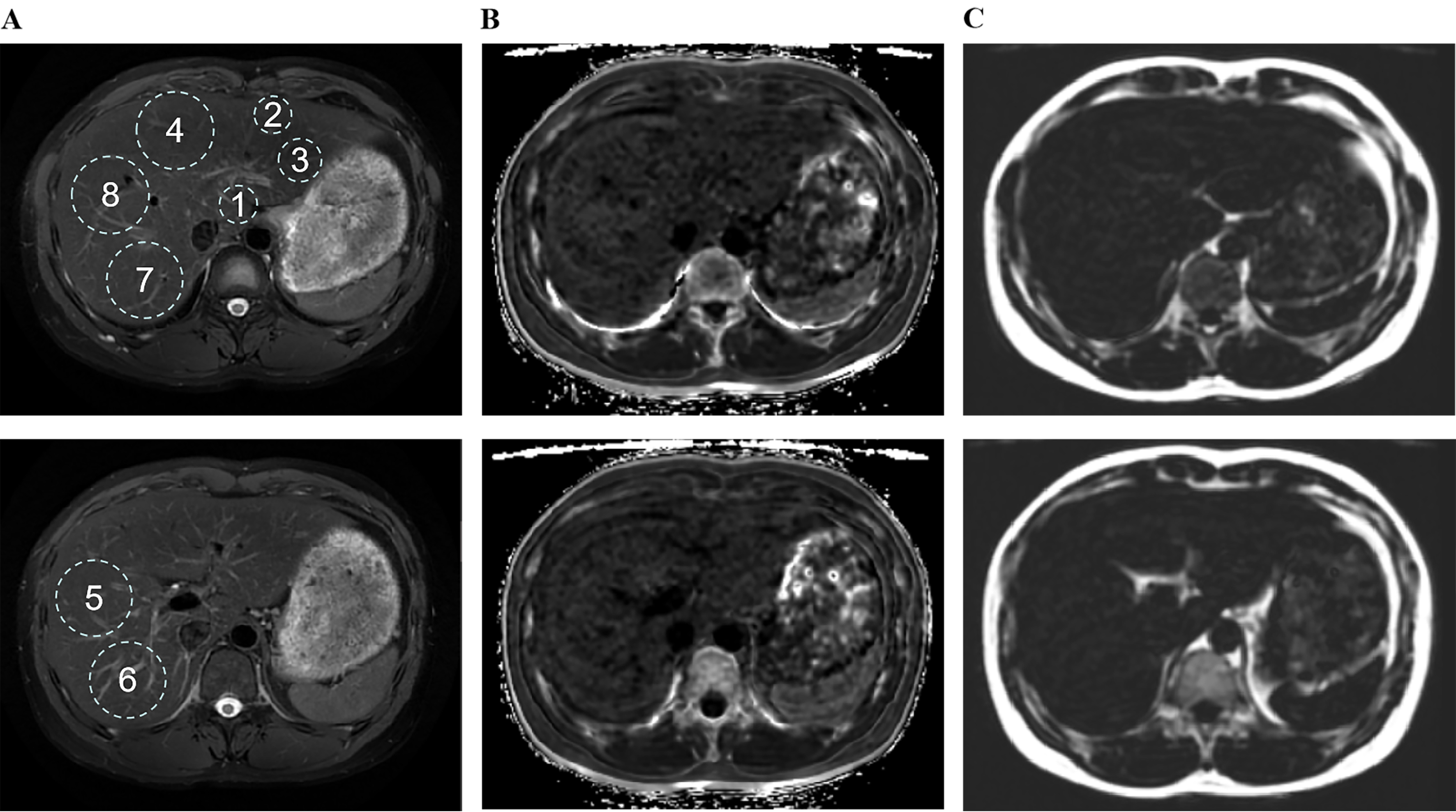 A multimodal neuroimaging and hepatic imaging analysis for hepatic-type and neurological-type Wilson’s disease