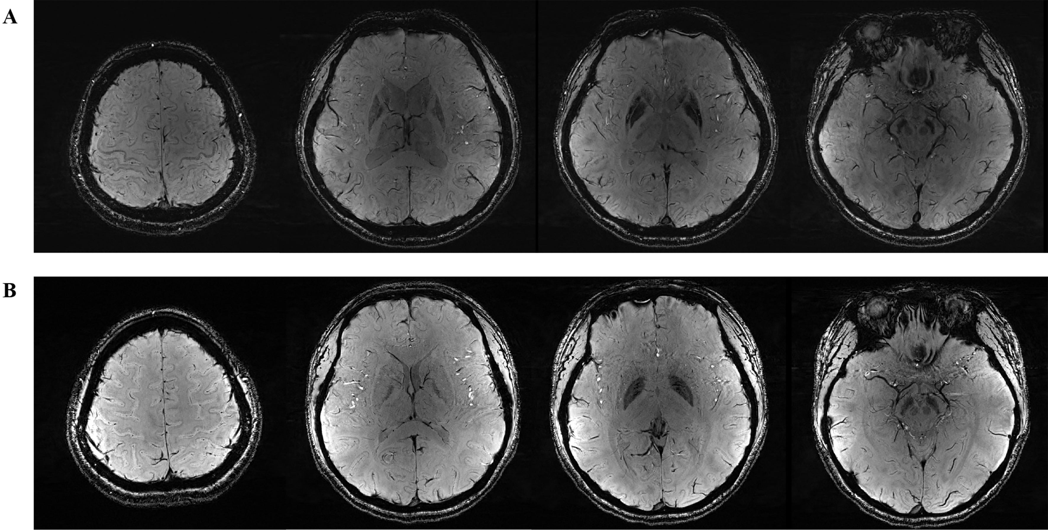 A multimodal neuroimaging and hepatic imaging analysis for hepatic-type and neurological-type Wilson’s disease