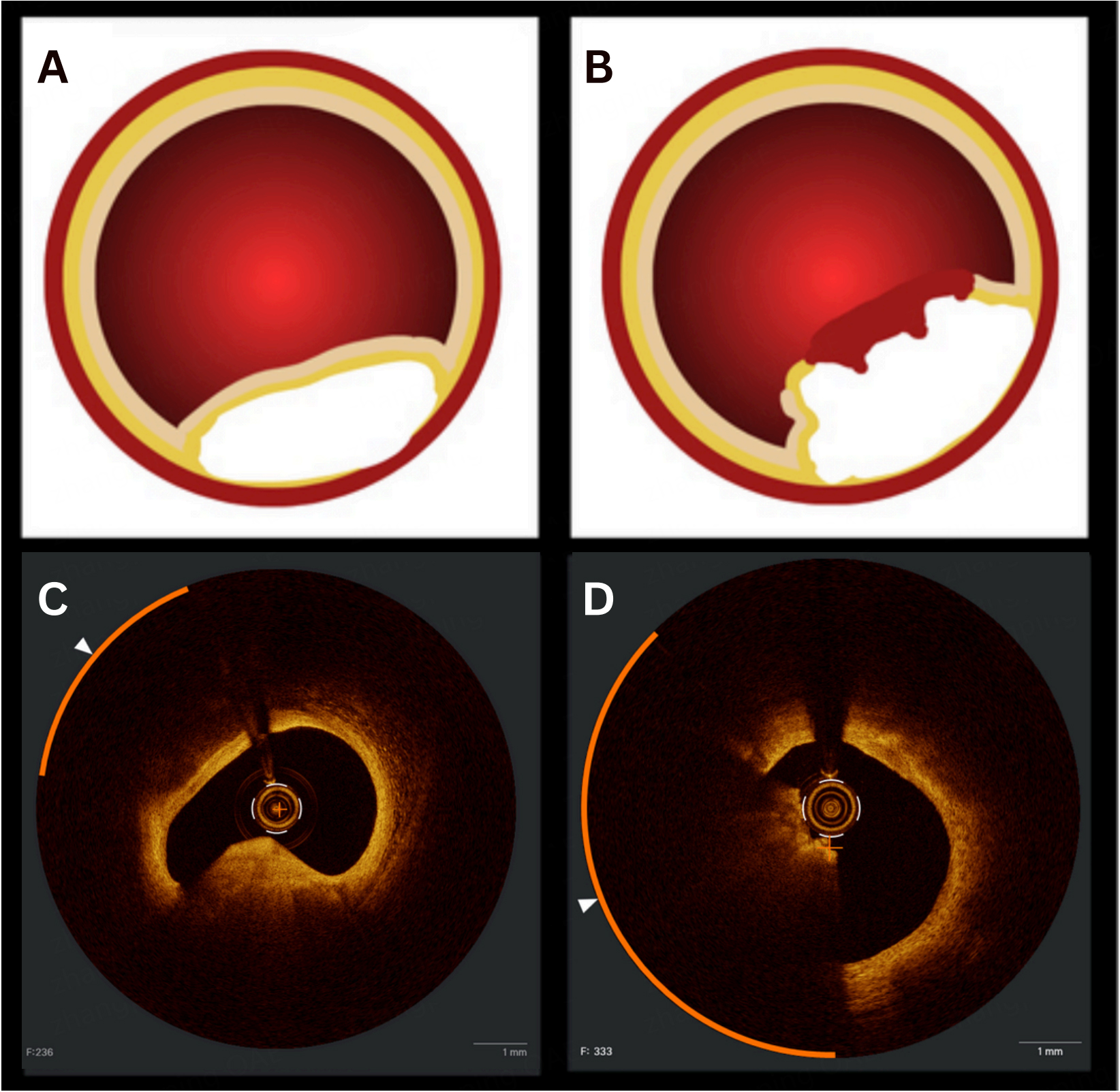 Calcified coronary nodules: pathophysiology, diagnosis, and interventional challenges