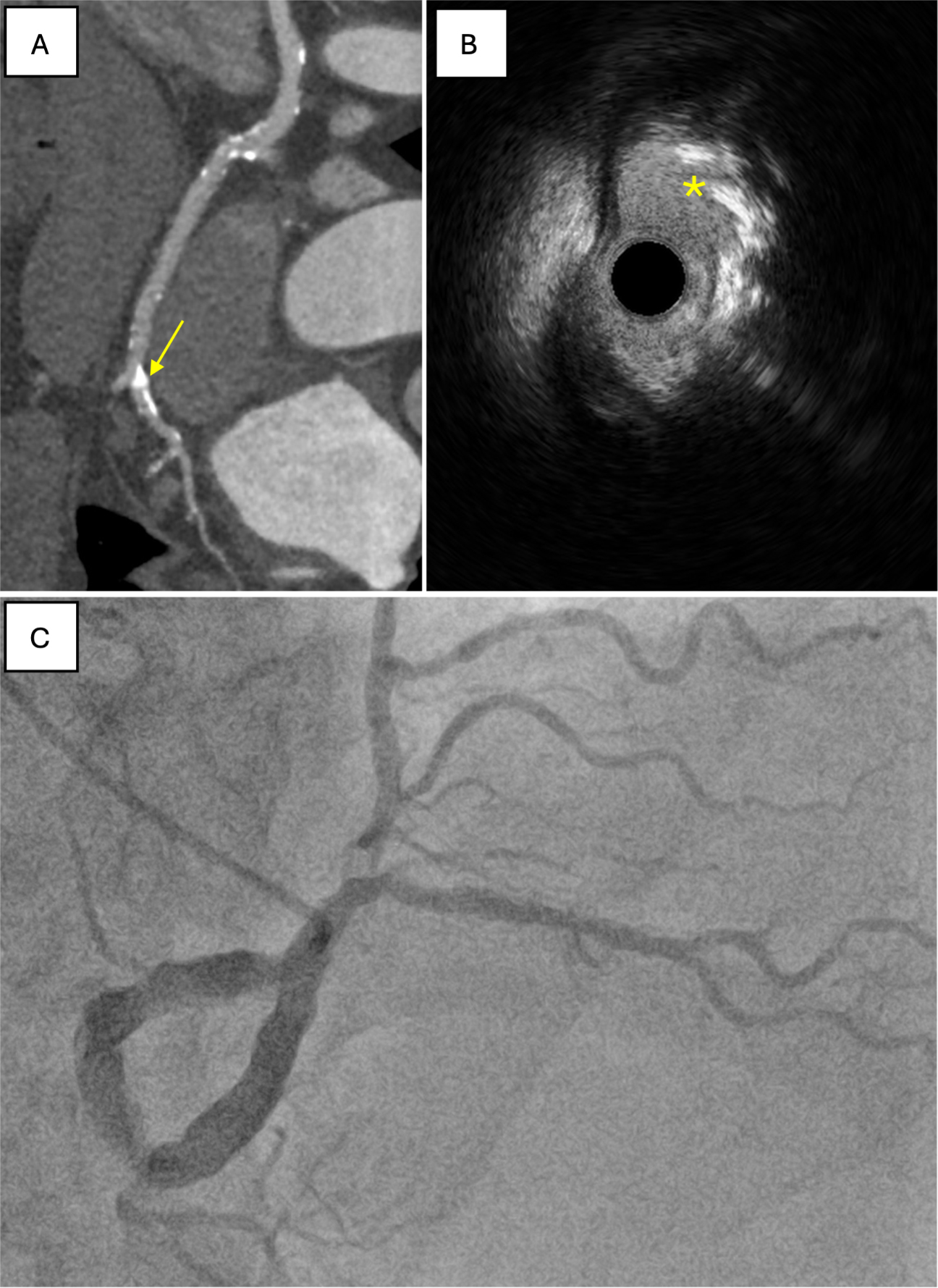 Calcified coronary nodules: pathophysiology, diagnosis, and interventional challenges
