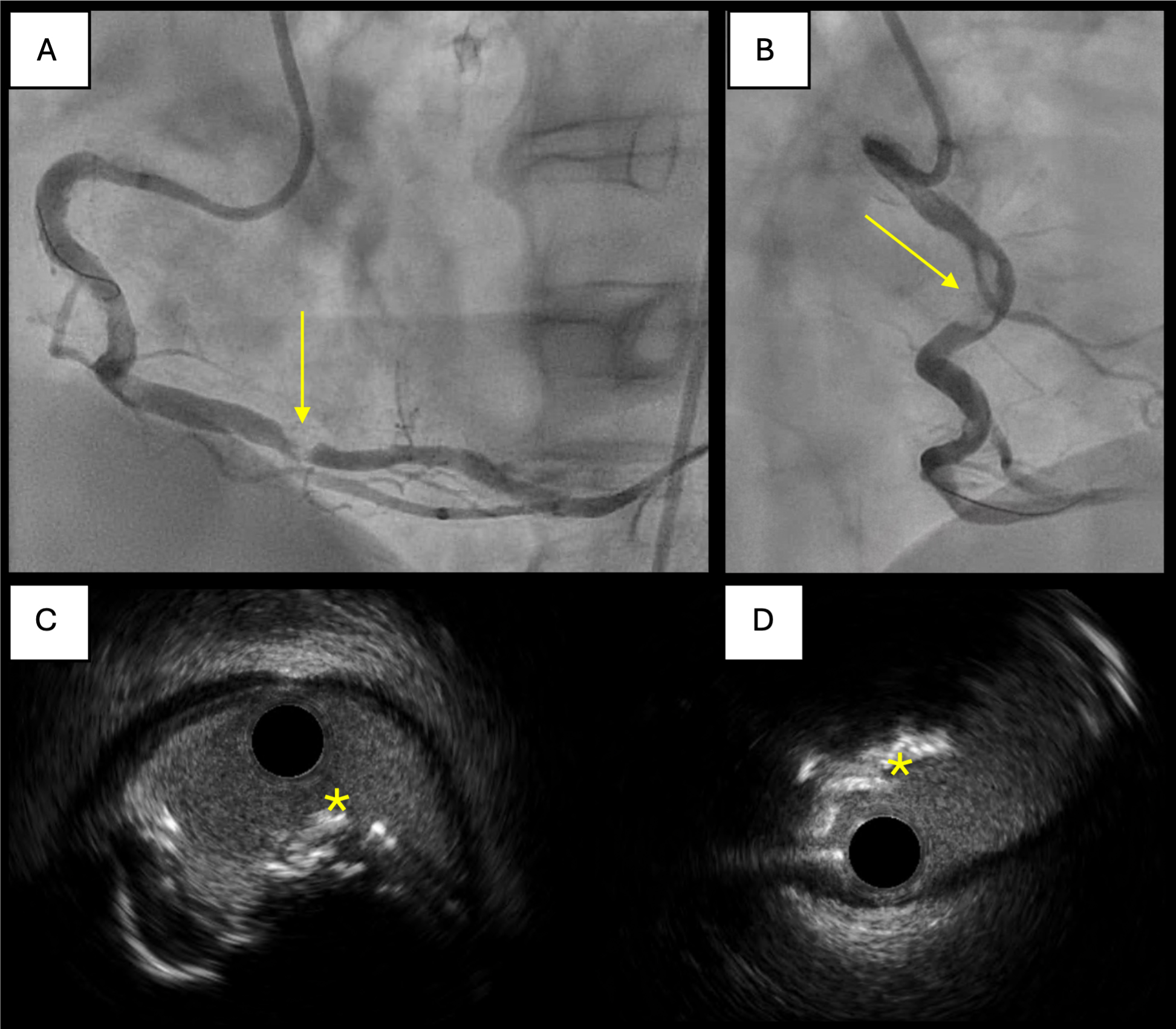 Calcified coronary nodules: pathophysiology, diagnosis, and interventional challenges
