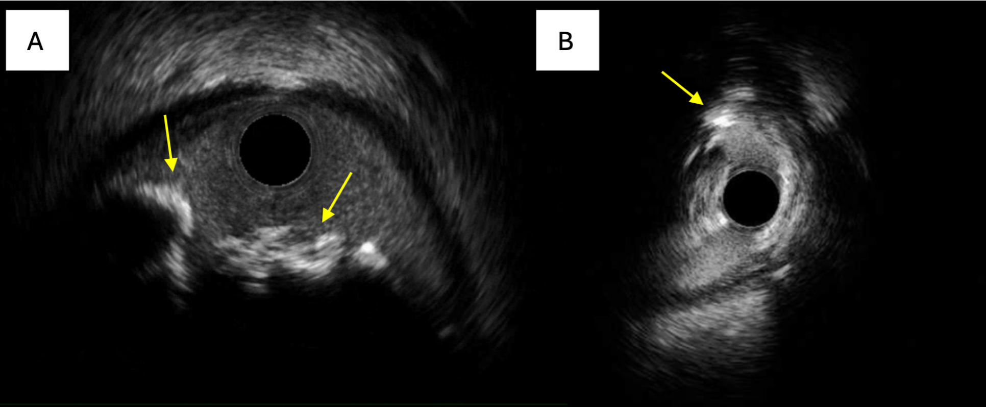 Calcified coronary nodules: pathophysiology, diagnosis, and interventional challenges