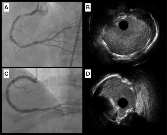 Calcified coronary nodules: pathophysiology, diagnosis, and interventional challenges