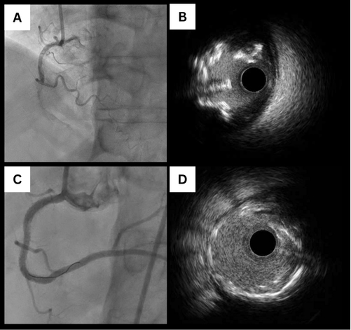 Calcified coronary nodules: pathophysiology, diagnosis, and interventional challenges